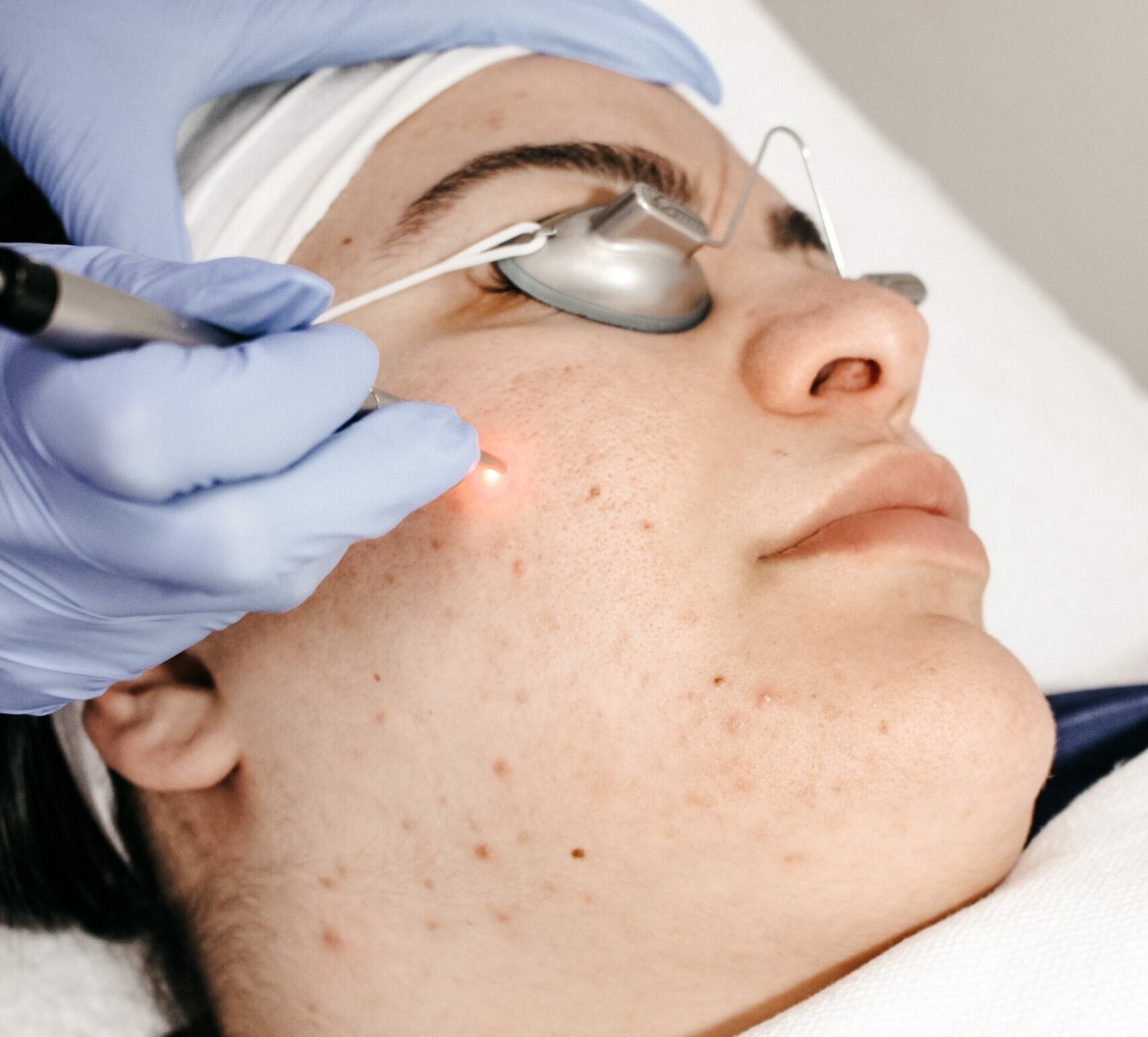 Acne siganture facial treatment