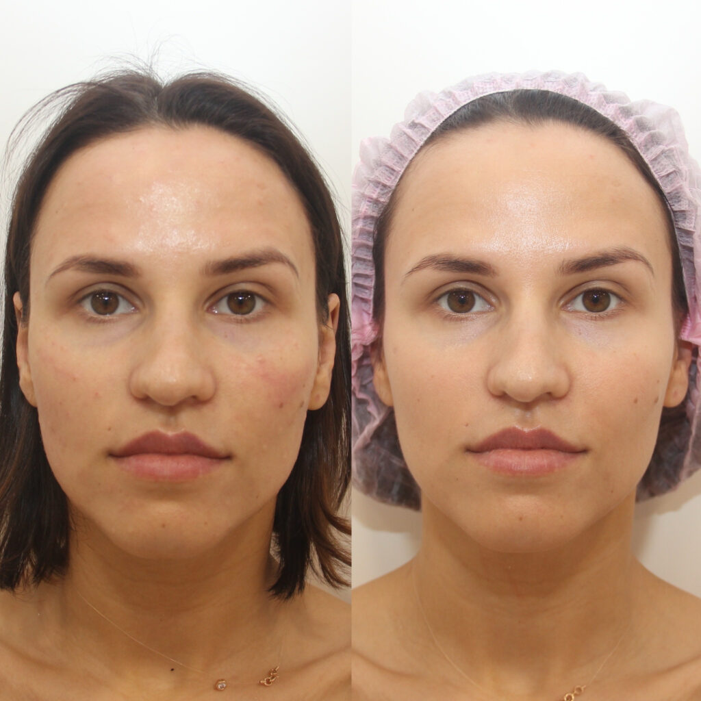 BioRePeel at Global Skin Clinicis