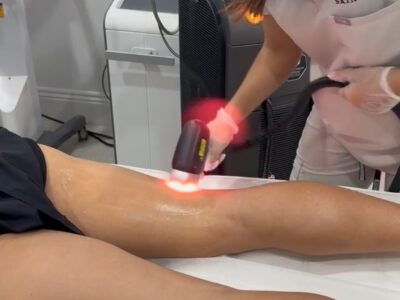 Laser Hair Removal